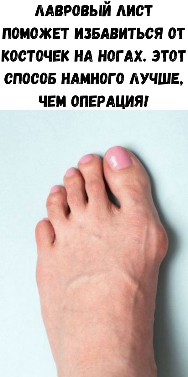 Лавровый лист поможет избавиться от косточек на ногах. Этот способ намного лучше, чем операция!