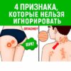 Цирроз печени: 4 тревожных симптома, которые нельзя игнорировать (№3 удивит вас)