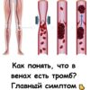Как понять, что в венах есть тромб? Называю главный симптом
