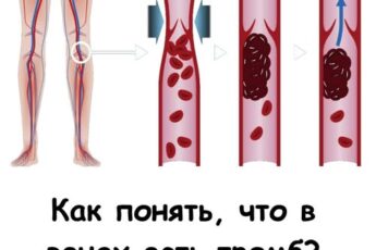 Как понять, что в венах есть тромб? Называю главный симптом