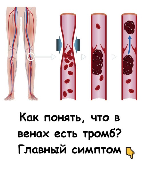 Как понять, что в венах есть тромб? Называю главный симптом Как понять, что в венах есть тромб? Называю главный симптом