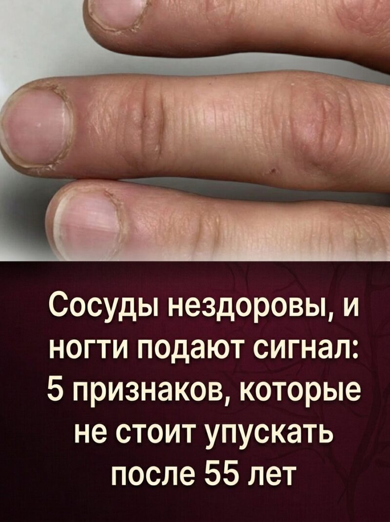 Состояние сосудов отражается на ногтях: 5 тревожных симптомов, на которые важно обратить внимание людям старше 55 лет. Состояние сосудов отражается на ногтях: 5 тревожных симптомов, на которые важно обратить внимание людям старше 55 лет.