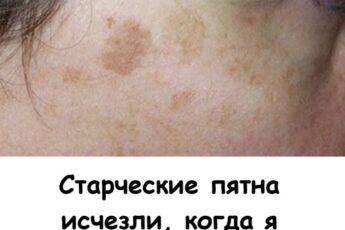 Старческие пятна ИСЧЕЗЛИ, когда я добавила в рацион эти 4 простых продукта.