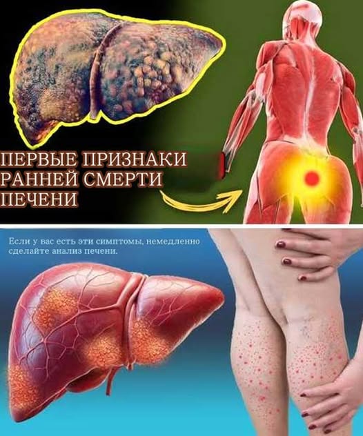 Узнайте 12 скрытых сигналов проблем с печенью. Симптомы, которые нельзя игнорировать, помогут вовремя защитить здоровье и сохранить жизнь. Узнайте 12 скрытых сигналов проблем с печенью. Симптомы, которые нельзя игнорировать, помогут вовремя защитить здоровье и сохранить жизнь.