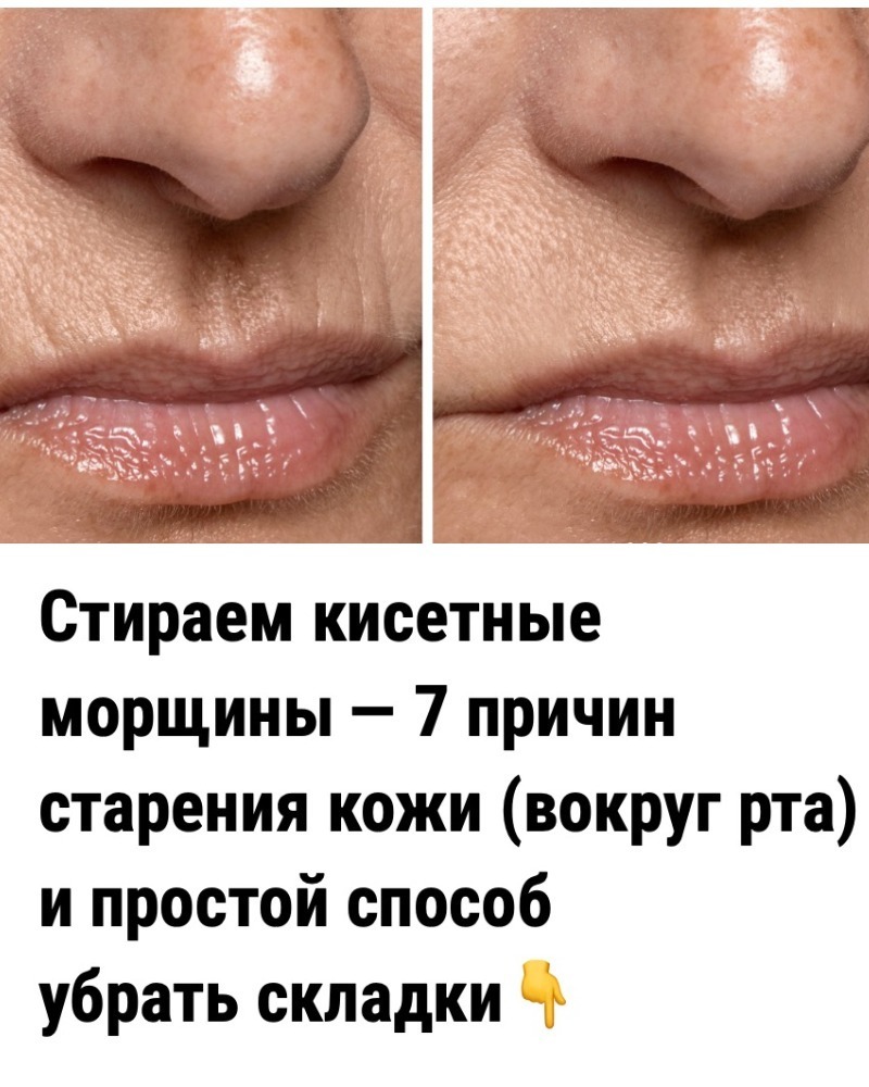 Стираем кисетные морщины — 7 причин старения кожи (вокруг рта) и простой способ убрать складки. Стираем кисетные морщины — 7 причин старения кожи (вокруг рта) и простой способ убрать складки.