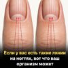 Если после 40 лет вы замечаете такие полосы на ногтях, это может означать, что вы...
