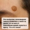 Симптомы и риски появления подозрительных новообразований на коже