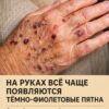 Снова эти багровые пятна… Они появляются на моих руках будто из ниоткуда, а запись к врачу — только через несколько недель. Что происходит и как мне действовать сейчас?
