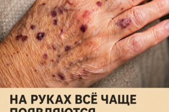 Снова эти багровые пятна… Они появляются на моих руках будто из ниоткуда, а запись к врачу — только через несколько недель. Что происходит и как мне действовать сейчас?