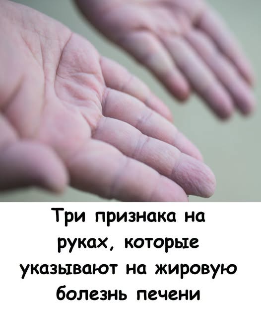 3 признака на руках, которые указывают на жировую болезнь печени 3 признака на руках, которые указывают на жировую болезнь печени